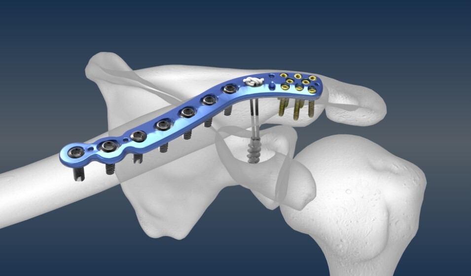 برغي عظمي وصفيحة عظمية برغي عظمي وصفيحة عظمية